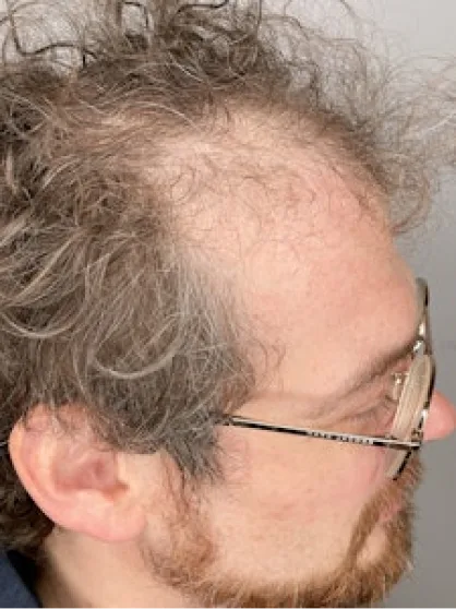 Before treatment result